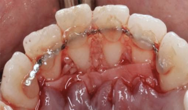 Successful Regenerative Therapy of Periodontal Defects Associated With Tongue Piercing: A Clinical Report