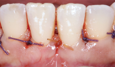 Successful Regenerative Therapy of Periodontal Defects Associated With Tongue Piercing: A Clinical Report