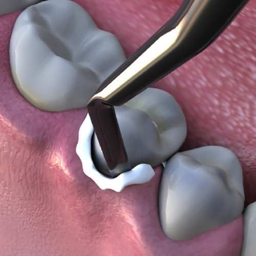 Success is in the Details: Cementation from Prep to Post-Op Ebook Library Image