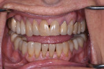 Preoperative retracted photograph with the teeth apart.