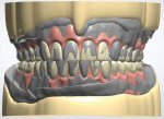 Fig 4. In design, the proposed tooth arrangement (pink/white) is registered with the STL file of the scanned existing dentures (gray) to show a match between both files.