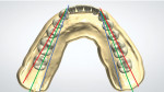 Fig 7. To improve function, the posterior teeth are set according to Pound’s triangle in order to provide stability.