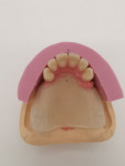 Fig 10. The setup of the upper anterior teeth with a silicone matrix.