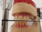 Fig 11. The setup of the lower anterior teeth with slight nesting.