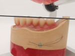 Fig 12 and Fig 13. The setup of the posterior teeth in the mandible, taking into account the information from the model analysis (eg, base static line passes through central fissures).