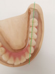 Fig 12 and Fig 13. The setup of the posterior teeth in the mandible, taking into account the information from the model analysis (eg, base static line passes through central fissures).