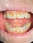 (1.) Pretreatment retracted view with the teeth apart. Note the marginal staining and gingival recession as well as the severe anterior crowding and malrotation of the dentition.
