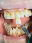 (2.) Shade matching was performed to select the appropriate tooth-colored composite.