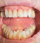 (8.) Posttreatment view of the restorations after the addition and shaping of the gingiva-shade composite.