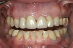 Fig 5. The mandibular incisors from 2008 showed minimal change in attrition.