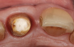 (8.) The sodium-perborate mixture was placed into the pulp chamber of the endodontically treated tooth following gutta-percha removal, and a cotton plug was placed over the mixture.