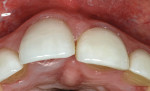Fig 3. The labial malposition of tooth No. 8
was apparent from the occlusal incisal view. The fact that the tooth was malpositioned allowed the strategy of palatal implant positioning within the dental arch and restorative undercontouring
to correct the gingival profile and free gingival margin location.