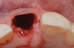 Fig 5. Tooth No. 8 was carefully excised in a flapless surgical approach.
