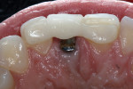Fig 1. During the healing phase a layered zirconia Maryland bridge was used due to hard- and soft-tissue augmentation that was performed simultaneously with the extraction and implant-fixture placement. The etched enamel was primed with All-Bond Universal® adhesive (Bisco). The bridge was treated with Z-Prime Plus and luted with flowable composite.