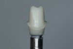 Fig 6. The CAD/CAM hybrid zirconia abutment was joined to the titanium base using Z-Prime Plus and TheraCem. Enough TheraCem was used to ensure complete contact between the titanium base and the zirconia abutment. The
opacity of the TheraCem prevented darkness from showing through the zirconia.