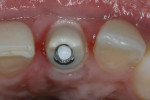 Fig 9. Before final cementation, the prosthetic screw was torqued, which was repeated after 1 minute. Polytetrafluoroethylene tape was condensed into the screw channel, leaving at least 3 mm from the top of the screw channel. This space would serve as an air gap to minimize cement from flowing subgingivally.