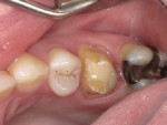 Fig 1. A patient presented with an in-office milled crown on tooth No. 3 that had been cold-sensitive since placement 2 years prior. Upon radiographic examination, the distal margin was open. Due to these circumstances, it was decided to remove the crown. The restoration was thus removed and the preparation refined (as shown).