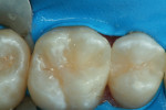 Fig 9. After final curing was completed, the sectional matrix was removed and additional curing was done near the gingival margins from the facial and lingual aspects to ensure thorough proximal cure after matrix removal. The rubber dam isolation then was removed and the occlusion was checked with articulating film (AccuFilm® II, Parkell Inc., parkell.com). Any minor adjustments were performed with an interproximal finishing diamond (Komet USA LLC, kometusa.com).