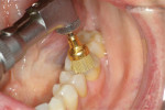 Fig 10. After the area was shaped with a Dura-Green® stone (Shofu Dental Corp., shofu.com) and a 7902 flame finish bur (Microcopy Dental) to remove excess flash, it was polished using Jiffy® composite polishing brushes (Ultradent Products).