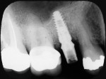 Fig 21. Radiograph of final abutment seated.