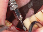 The implant is placed into the osteotomy site and torqued to 40 Ncm to achieve initial stability.