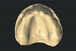 Fig 4. Screen shot of the intraoral scan with the color removed.