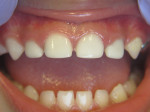 Patient in Figure 1 treated with 4 anterior Zirconia Crowns, Image courtesy of Travis M. Nelson, DDS, MSD, MPH.