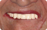 Fig 6. The esthetic/functional problems are unchanged when simple denture duplications are used as try-ins.
