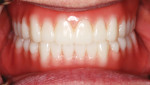 Fig 24. The final denture results at clinical delivery.