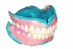 Fig 26. Due to the proprietary design and production of the try-in, after records are complete and scanned, the try-in itself can be processed via normal relining/rebasing procedures to produce an economy denture as a backup or transitional/healing prosthesis.