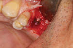 An implant surgical protocol was followed to precisely position the first implant at the crest of the edentulous ridge and at least 2 mm from the adjacent root structure and along the central groove area of the adjacent dentition.