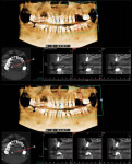 A postoperative CBCT analysis demonstrated proper positioning of the implants in the previously grafted surgical site.